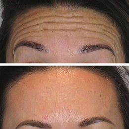 Botox / Xeomin Before & After Result 1