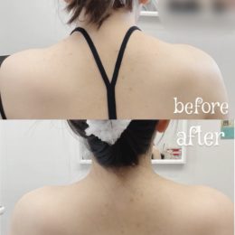 Botox / Xeomin Before & After Result 10