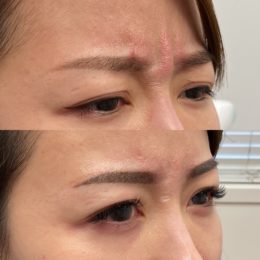 Botox / Xeomin Before & After Result 11