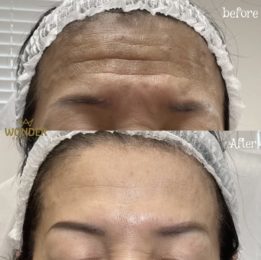 Botox / Xeomin Before & After Result 12