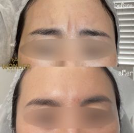 Botox / Xeomin Before & After Result 13