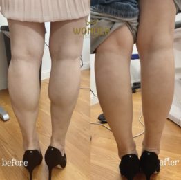 Botox / Xeomin Before & After Result 14