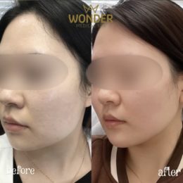 Botox / Xeomin Before & After Result 15