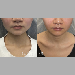 Botox / Xeomin Before & After Result 16