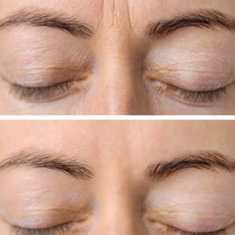 Botox / Xeomin Before & After Result 2