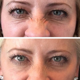 Botox / Xeomin Before & After Result 3