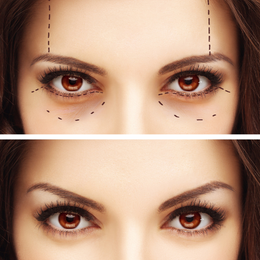 Botox / Xeomin Before & After Result 4