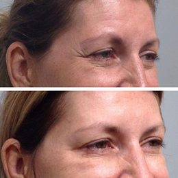 Botox / Xeomin Before & After Result 5