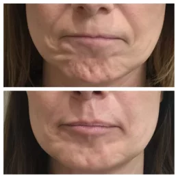 Botox / Xeomin Before & After Result 6