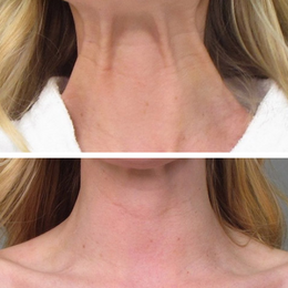 Botox / Xeomin Before & After Result 7