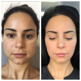 Botox / Xeomin Before & After Result 9