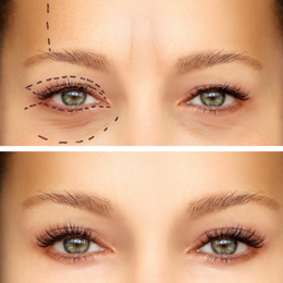 Fillers Before & After Result 1