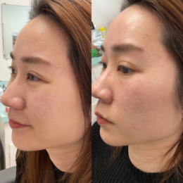 Fillers Before & After Result 13