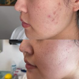 Fillers Before & After Result 14