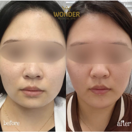 Fillers Before & After Result 15
