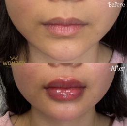 Fillers Before & After Result 16