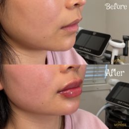 Fillers Before & After Result 17