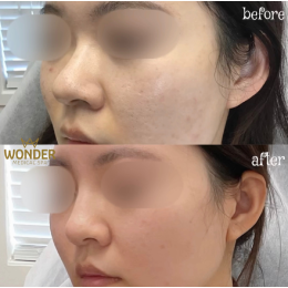 Fillers Before & After Result 18