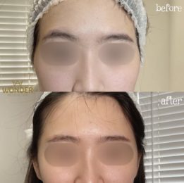 Fillers Before & After Result 19