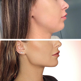 Fillers Before & After Result 2