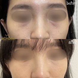 Fillers Before & After Result 20