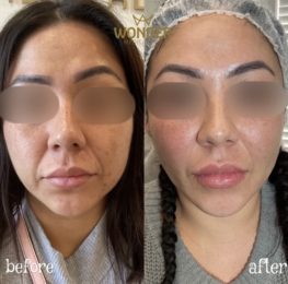 Fillers Before & After Result 21
