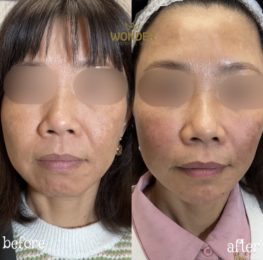 Fillers Before & After Result 22