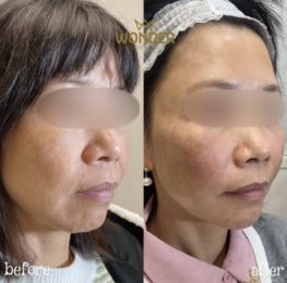 Fillers Before & After Result 23