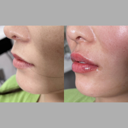 Fillers Before & After Result 24