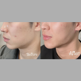 Fillers Before & After Result 25