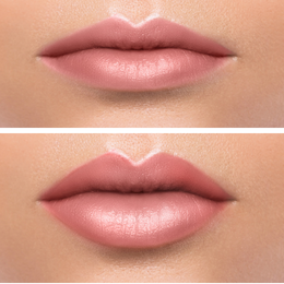 Fillers Before & After Result 3