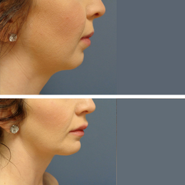 Fillers Before & After Result 4