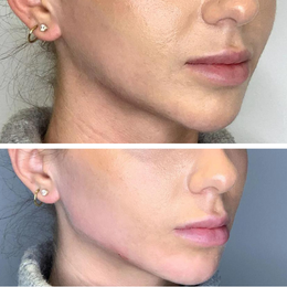 Fillers Before & After Result 5