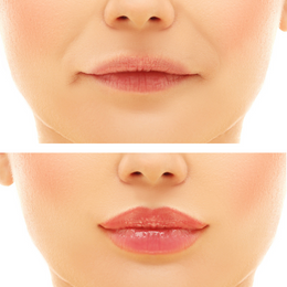 Fillers Before & After Result 6