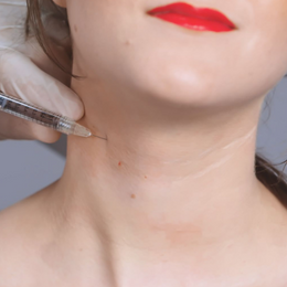 Fillers Before & After Result 9