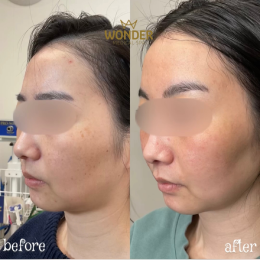 Lumecca Before & After Result 1
