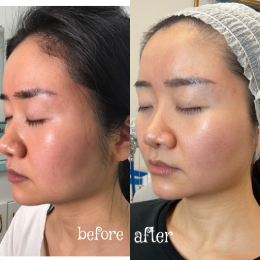 Morpheus8 Before & After Result 1