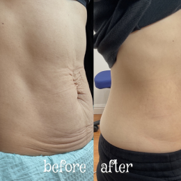 Morpheus8 Before & After Result 2