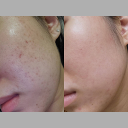 Morpheus8 Before & After Result 3