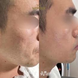 Morpheus8 Before & After Result 4
