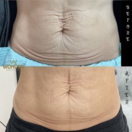 Morpheus8 Before & After Result 5