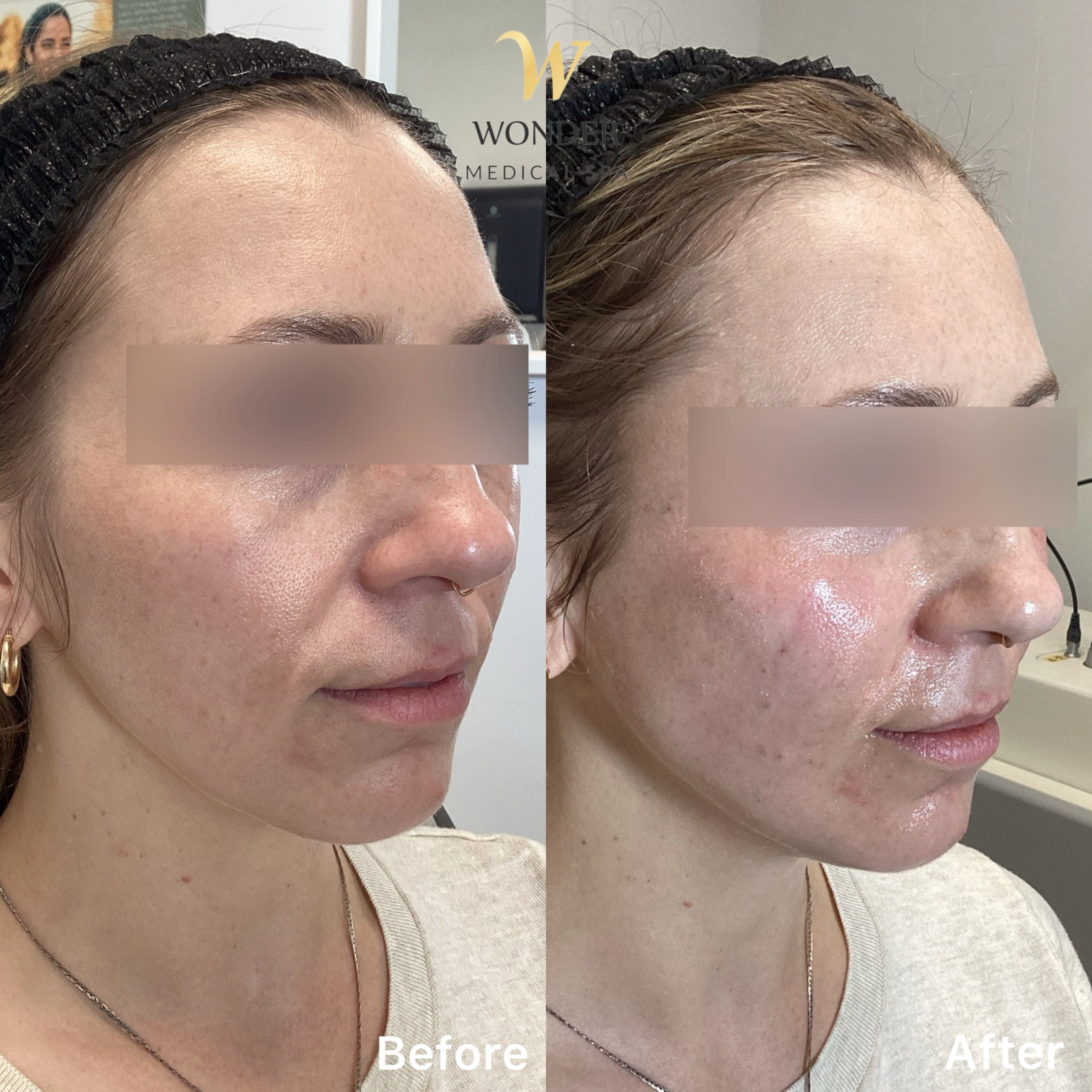 Filler Face 1 Result