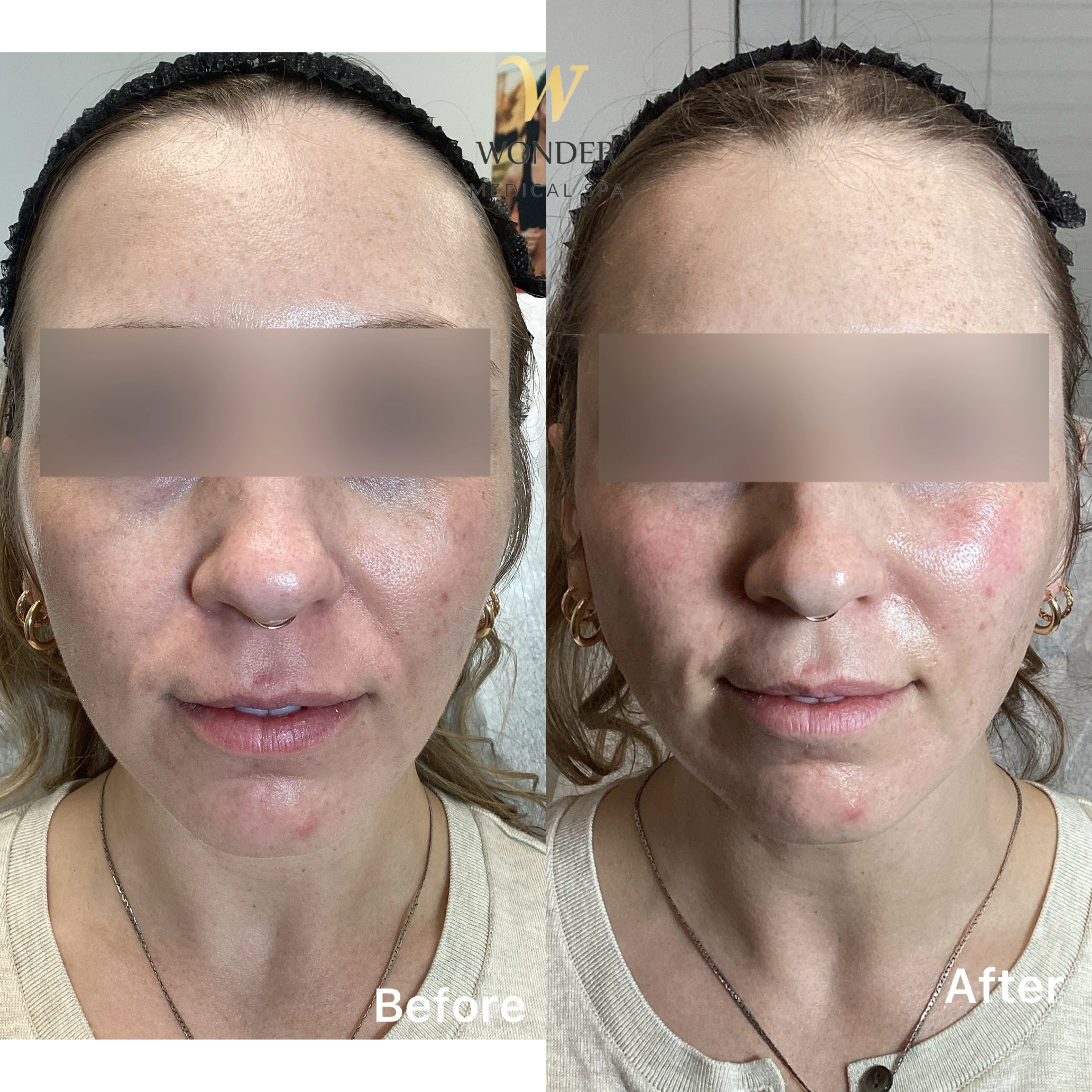 Filler Face 2 Result