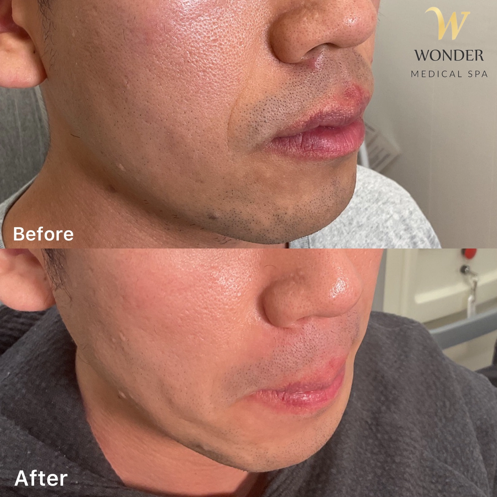 Filler Nasolabial Result