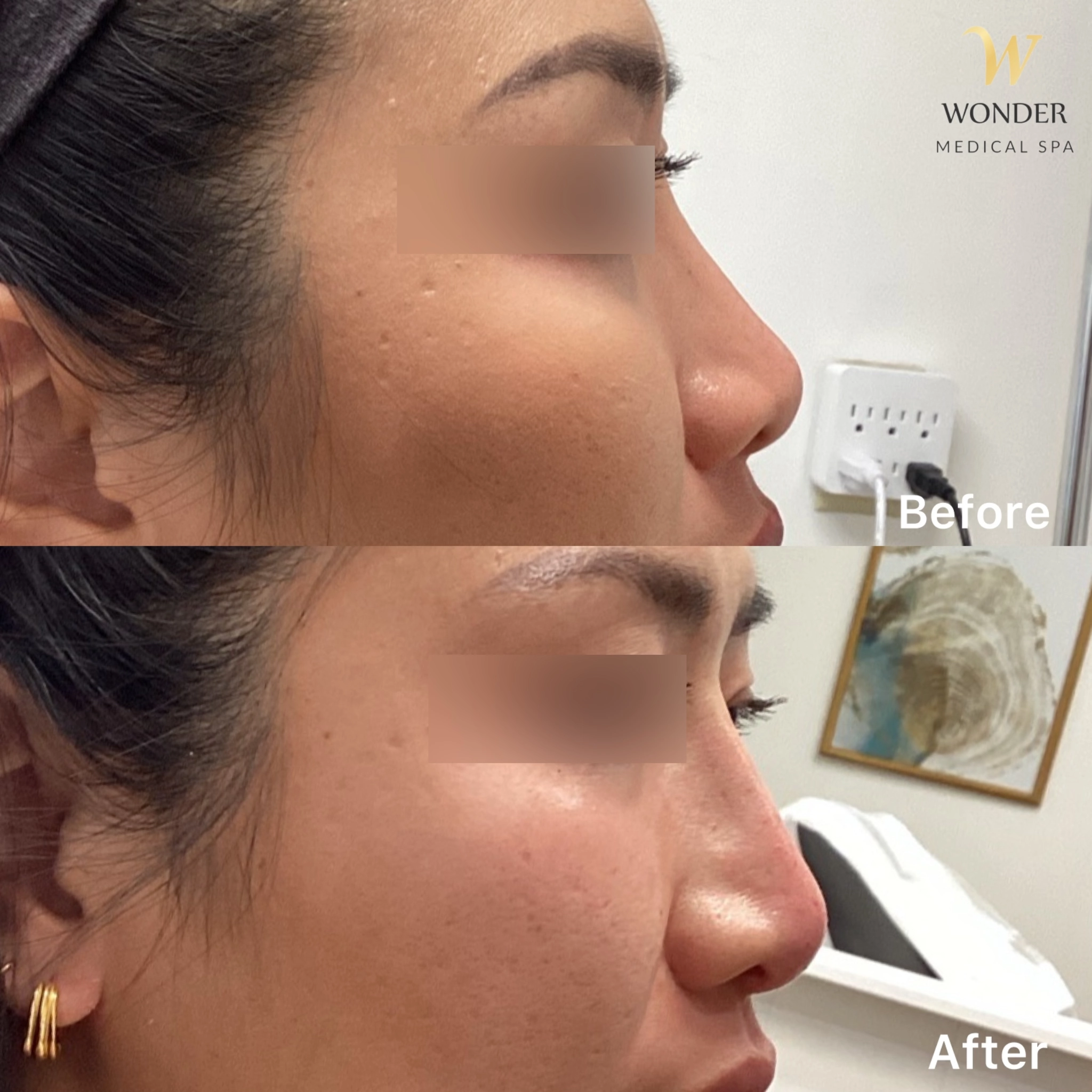 Filler Nose 1 Result