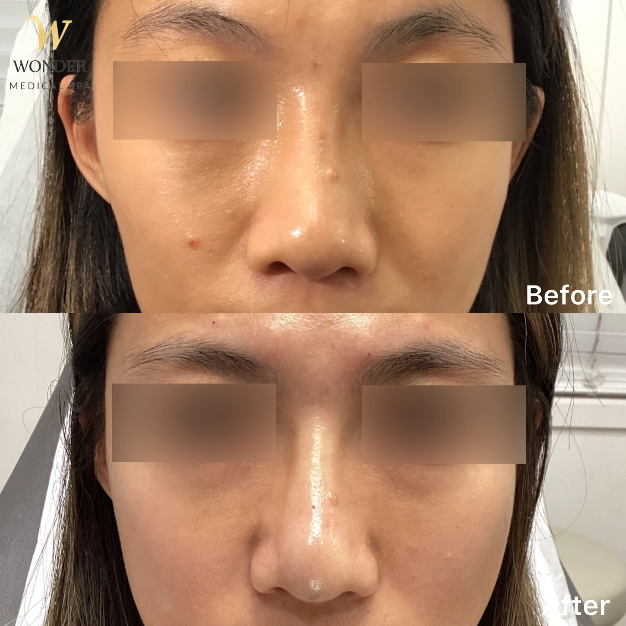 Filler Nose 2 Result