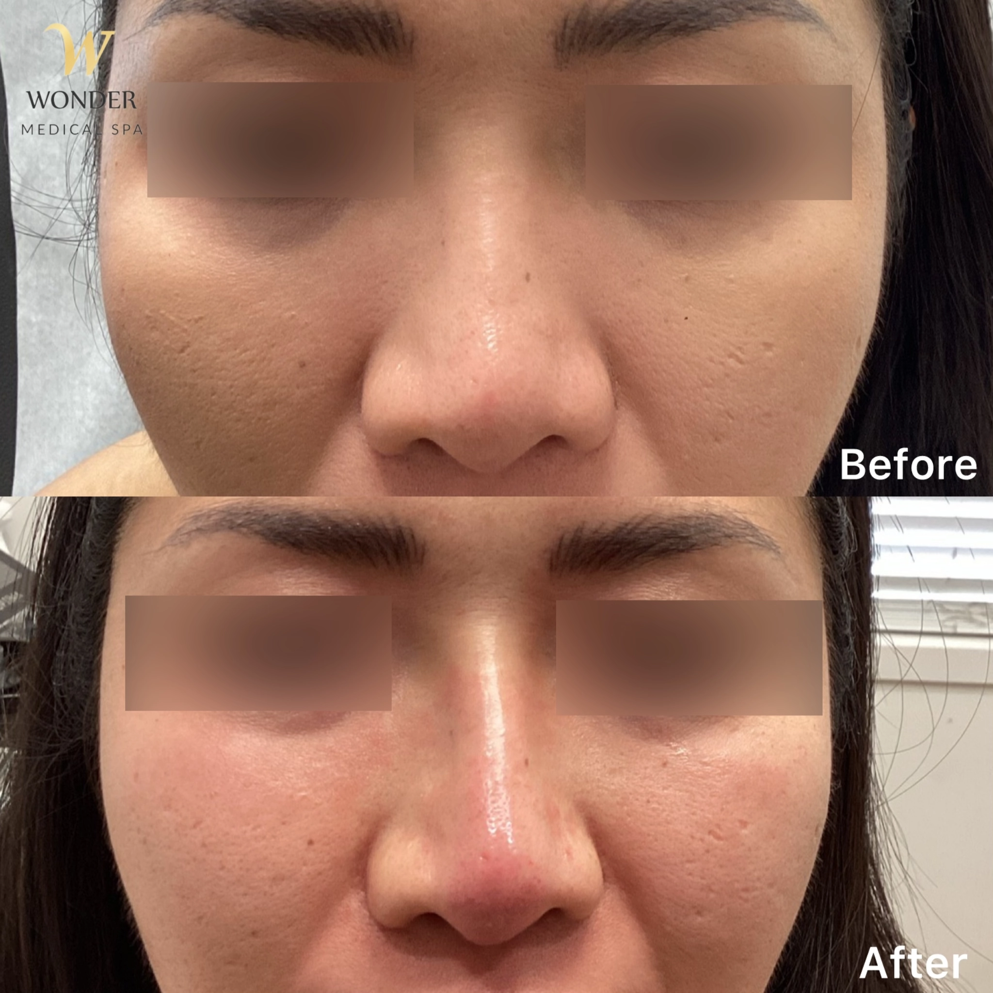 Filler Nose 3 Result