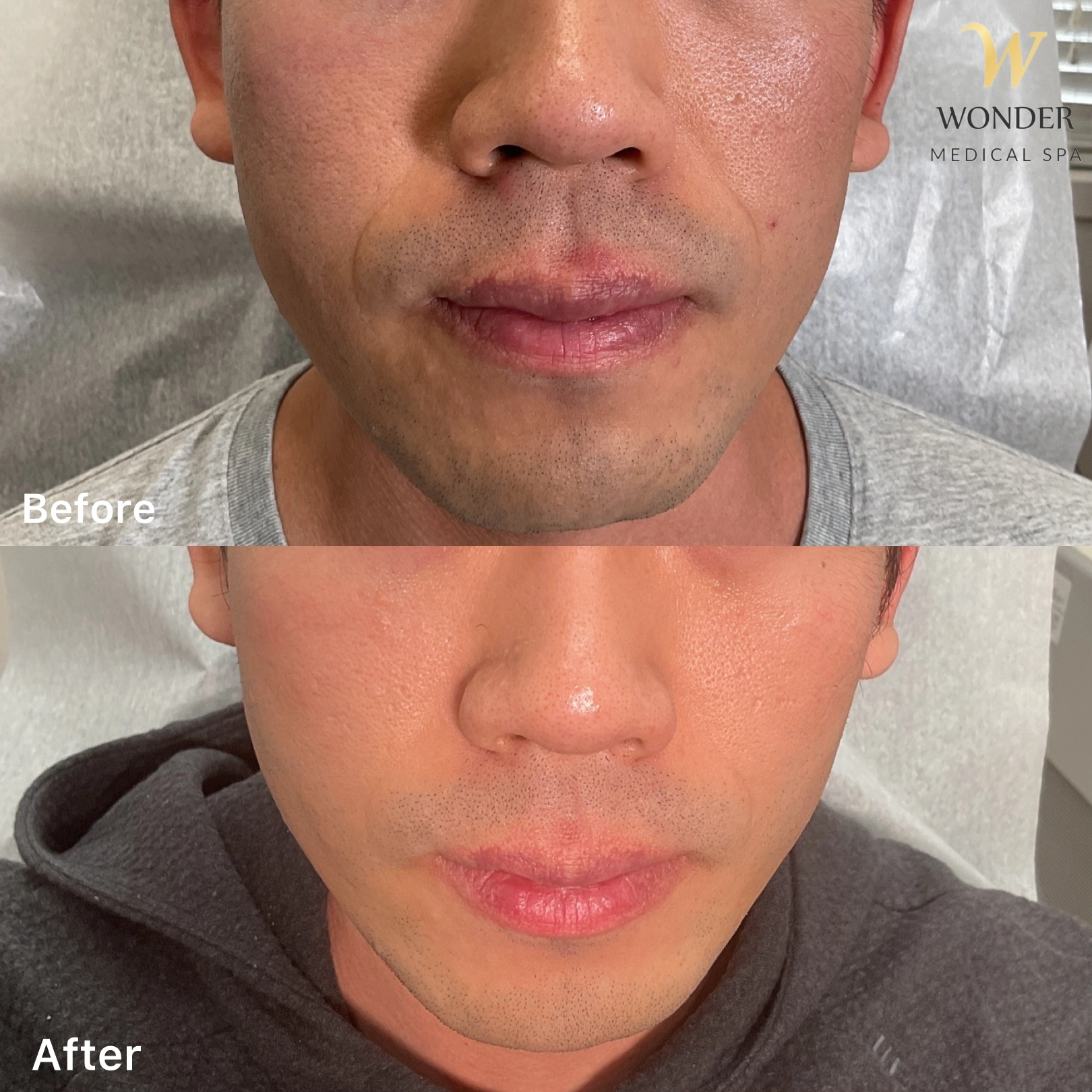 Morpheus 8 Filler Nasolabial Result