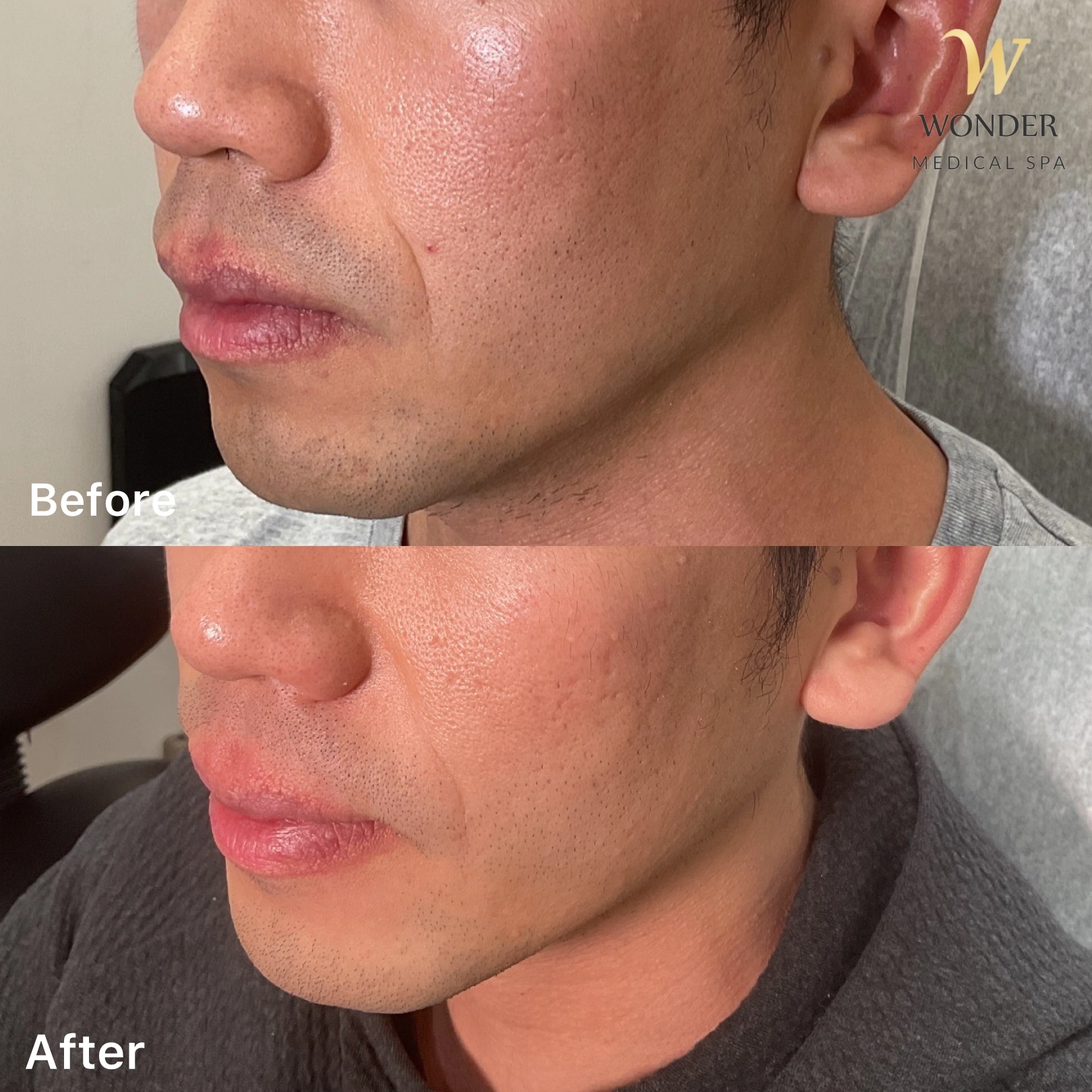 Morpheus 8 Resurfacing Result