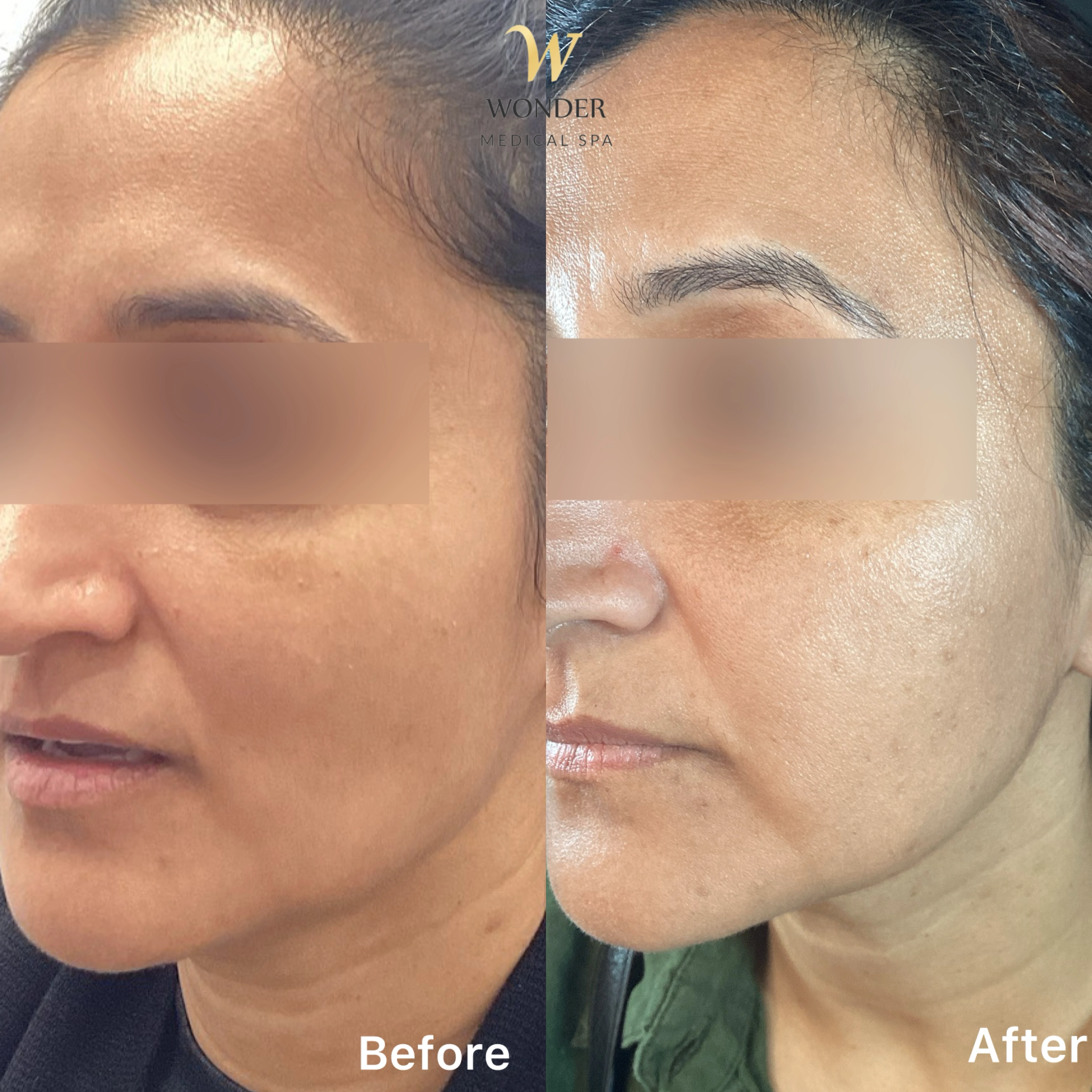 Sculptra Face 0 Result